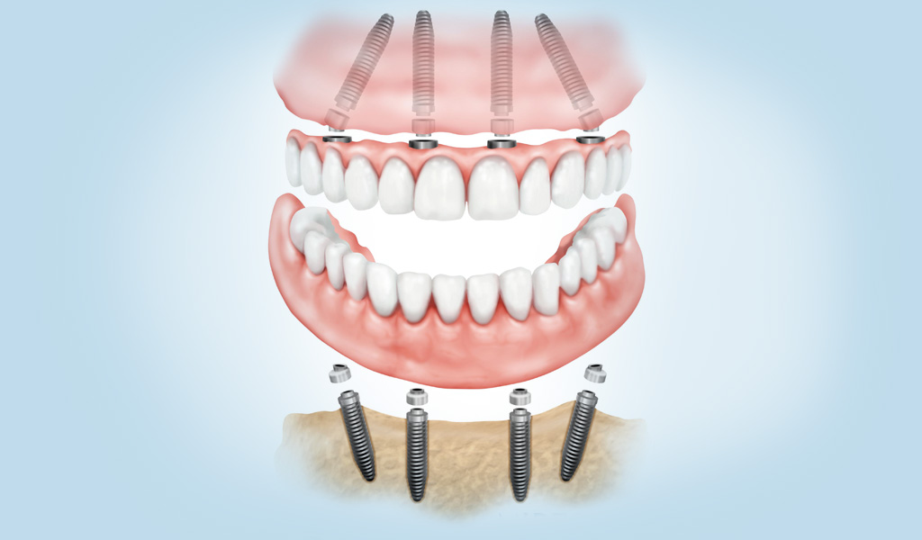 implants dentals a Manresa