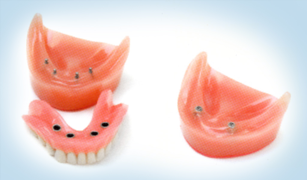 implants dentals a Manresa